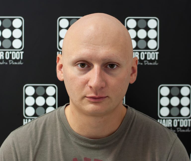 Alopecia Universalis Micropigmentare Scalp