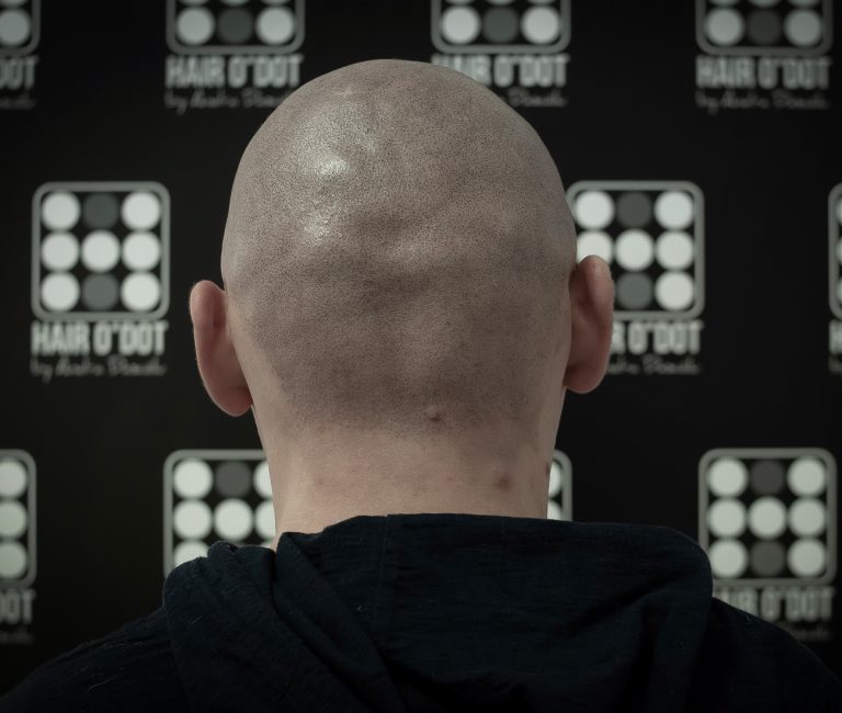 Alopecia Universalis Micropigmentare Scalp