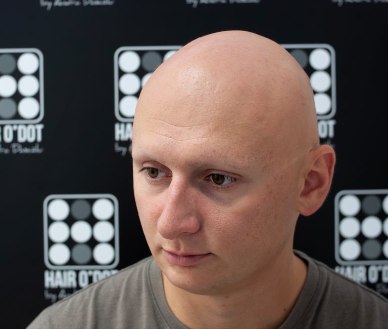 Alopecia Universalis Micropigmentare Scalp