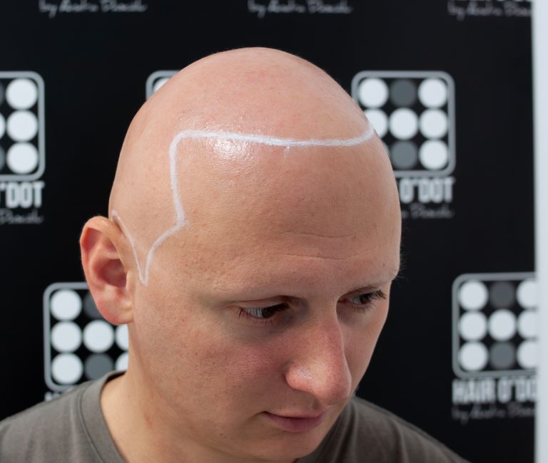 Alopecia Universalis Micropigmentare Scalp