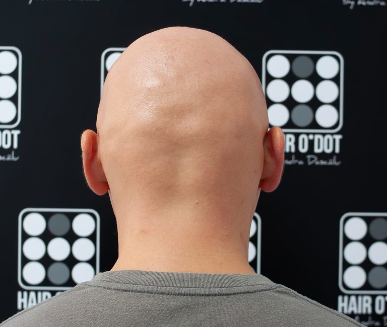 Alopecia Universalis Micropigmentare Scalp