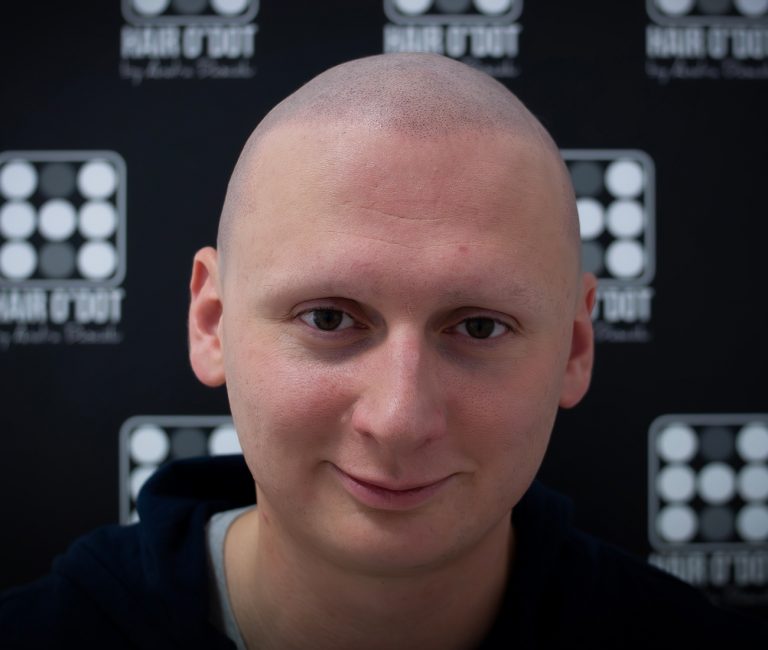 Alopecia Universalis Micropigmentare Scalp
