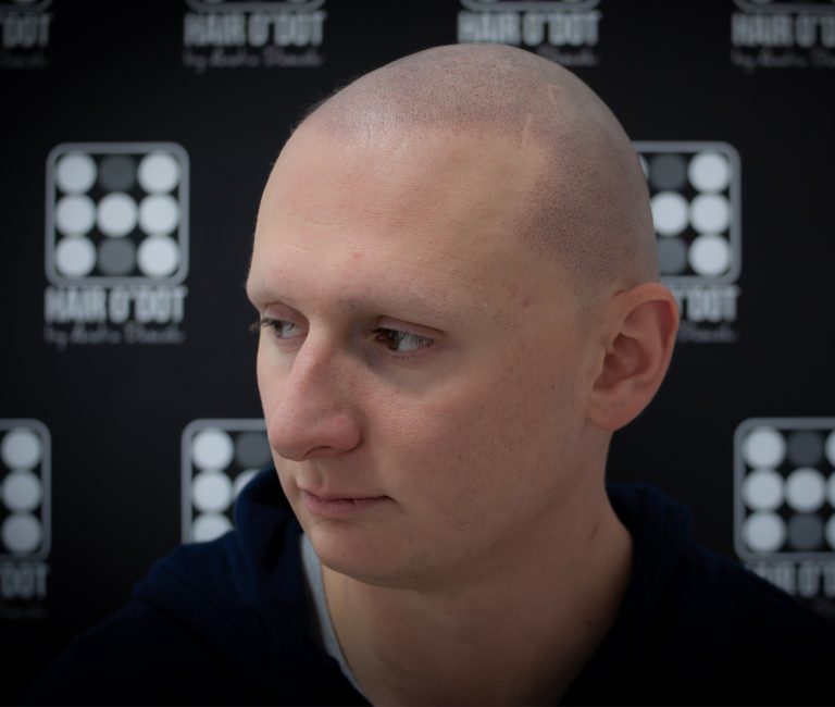 Alopecia Universalis Micropigmentare Scalp