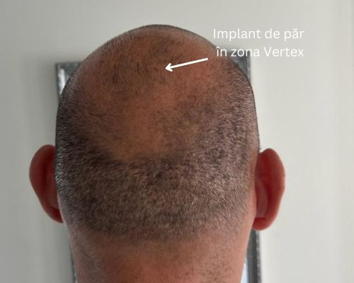 Implant de par cicatrici FUE