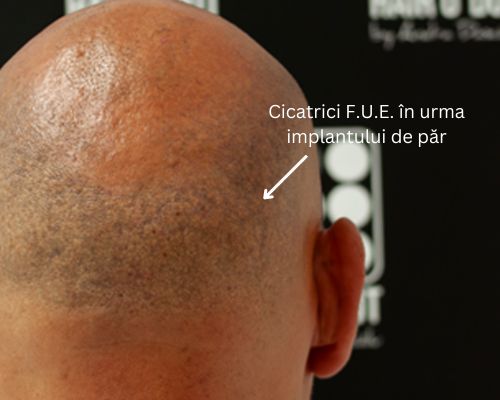 Cicatrici FUE Implant de par