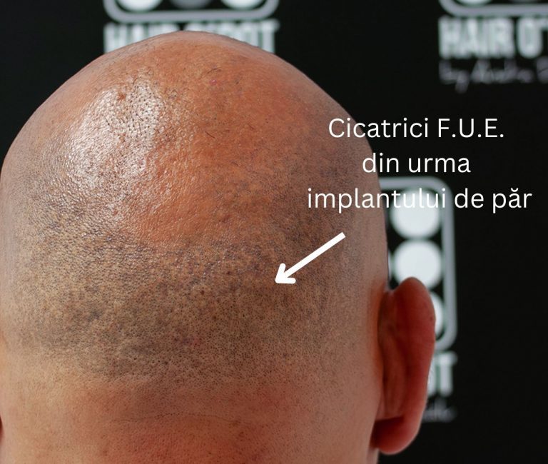 Micropigmentare Scalp Scalp Micropigmentation