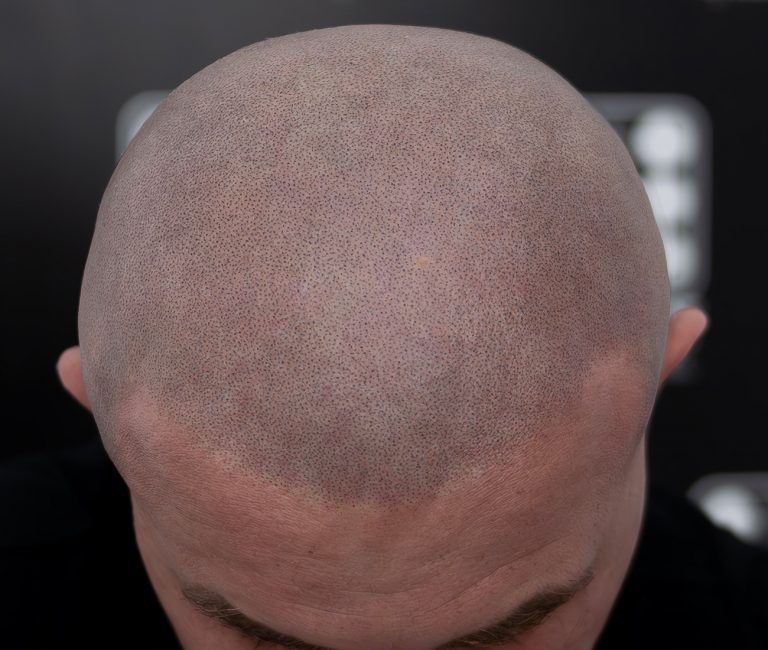 Alopecia Totalis Micropigmentare Scalp