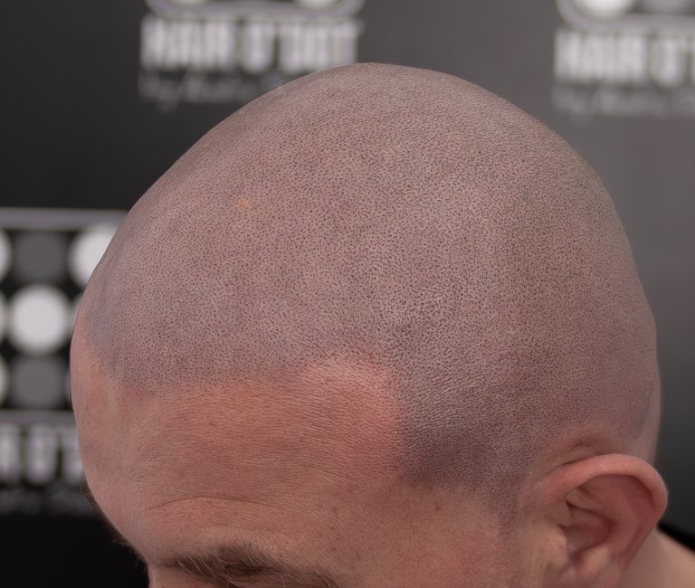 Alopecia Totalis Micropigmentare Scalp