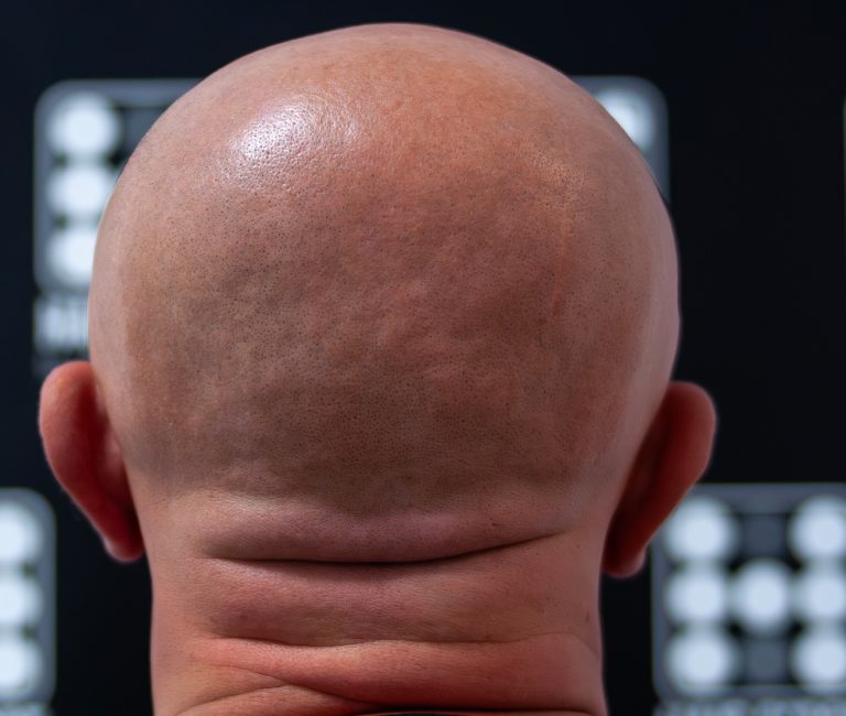 Alopecia Totalis Micropigmentare Scalp