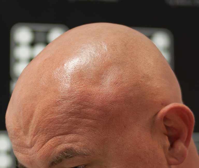 Alopecia Totalis Micropigmentare Scalp
