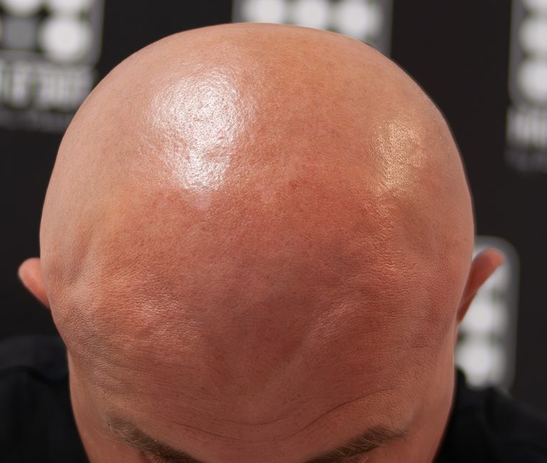 Alopecia Totalis Micropigmentare Scalp