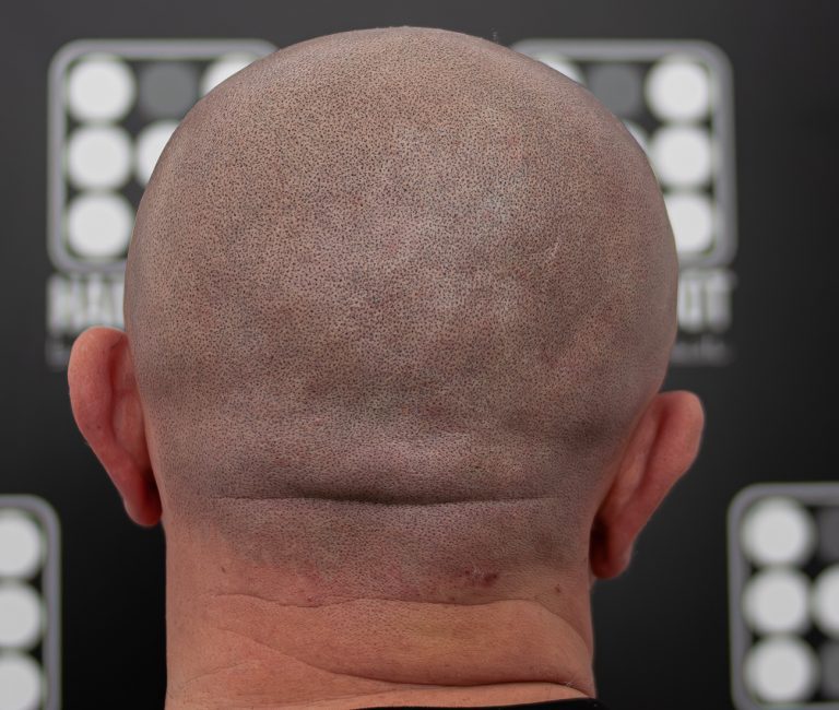 Alopecia Totalis Micropigmentare Scalp