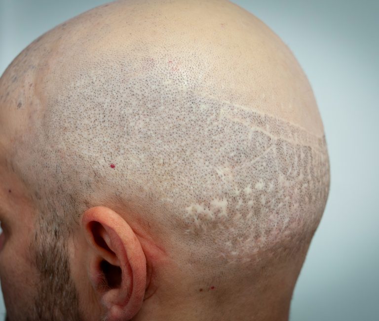 Micropigmentare Scalp Scalp Micropigmentation Cicatrici Implant de par