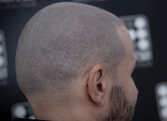 Micropigmentare Scalp Scalp Micropigmentation