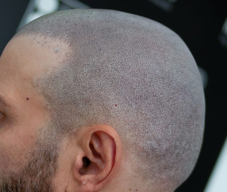 Micropigmentare Scalp Scalp Micropigmentation Cicatrici Implant de par