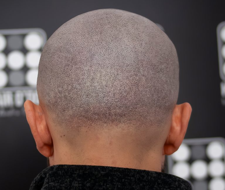 Micropigmentare Scalp Scalp Micropigmentation Cicatrici Implant de par