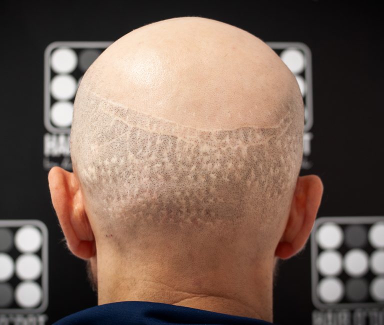 Micropigmentare Scalp Scalp Micropigmentation Cicatrici Implant de par