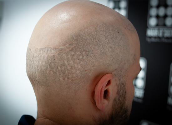 Micropigmentare Scalp Scalp Micropigmentation