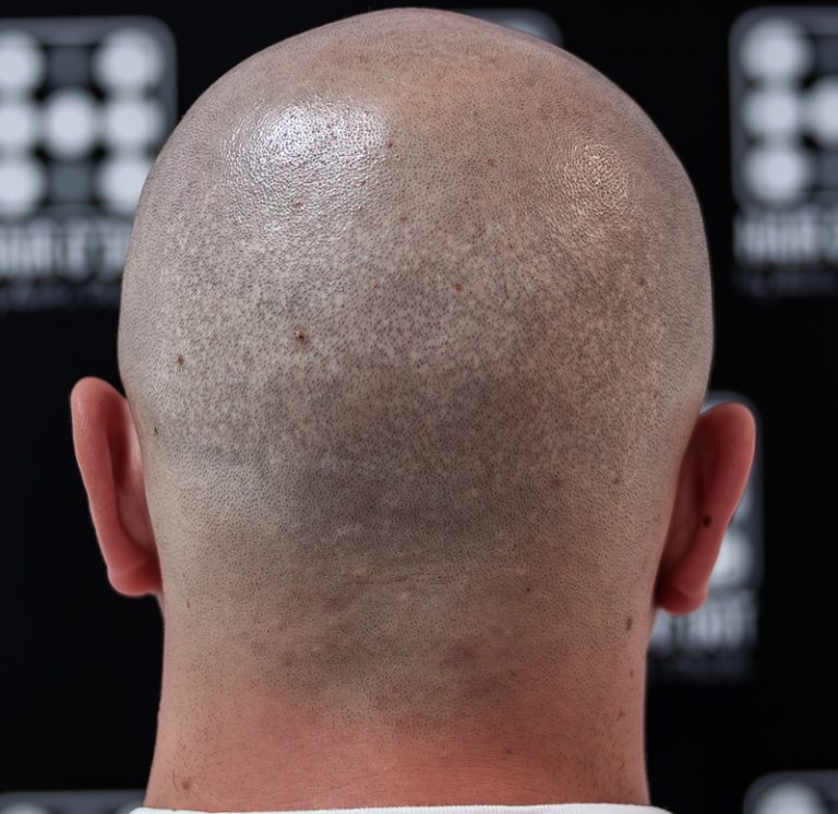 cicatrici implant de par FUE