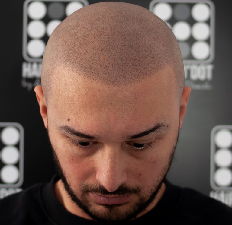 Micropigmentare Scalp Hairodot