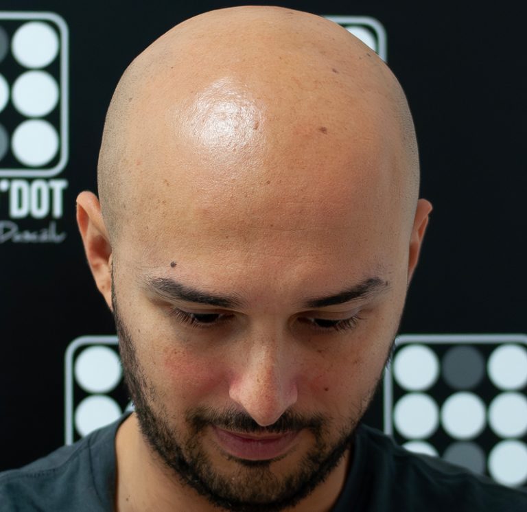 Micropigmentare Scalp Hairodot