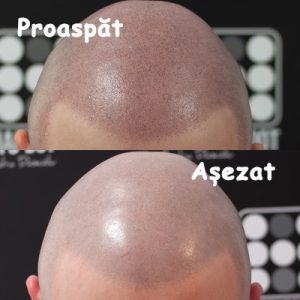 Micropigmentare Scalp Hairodot