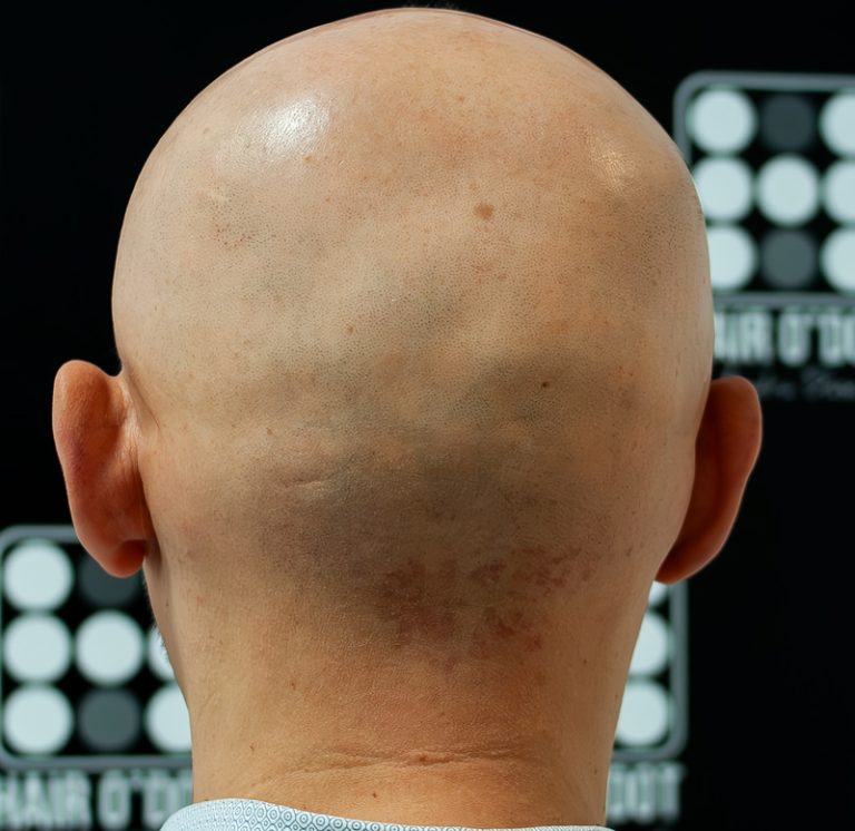 Alopecia Areata