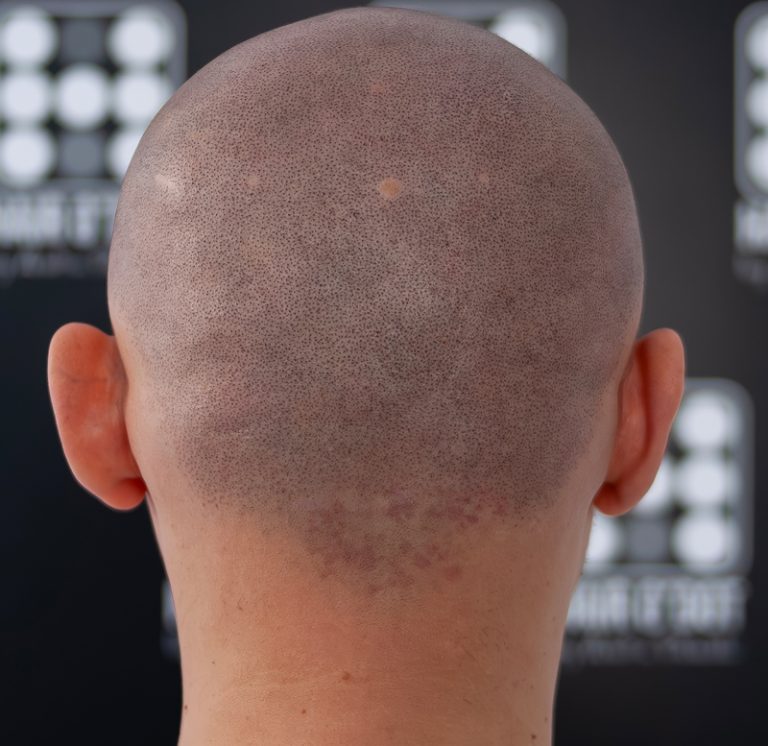 alopecia areata micropigmentare scalp