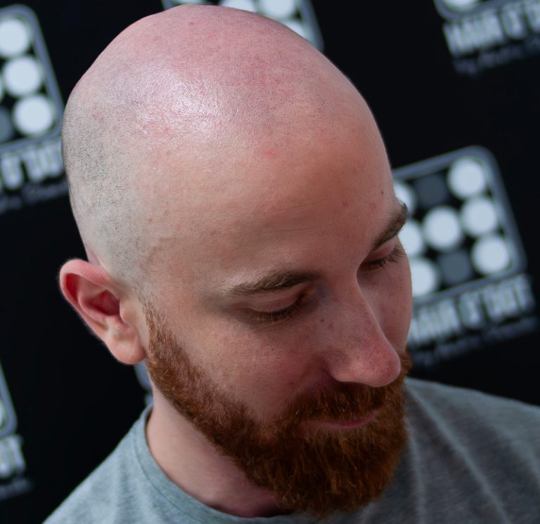 Micropigmentare Scalp Chelie Barbati