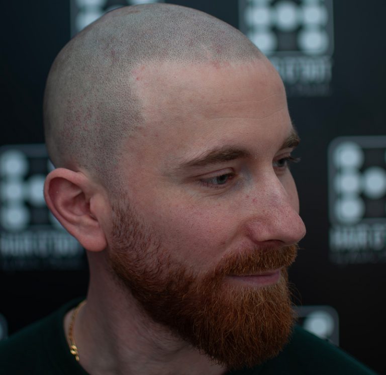 Micropigmentare Scalp Scalp Micropigmentation