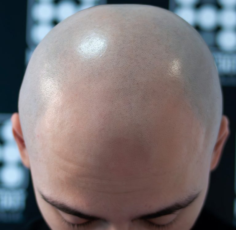 chelie barbati micropigmentare scalp
