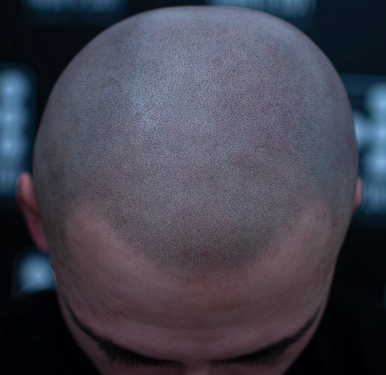 micropigmentare scalp scalp micropigmentation chelie barbati