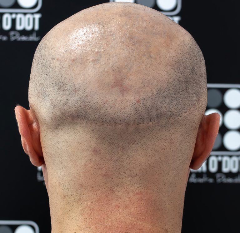 cicatrici implant de par micropigmentare scalp