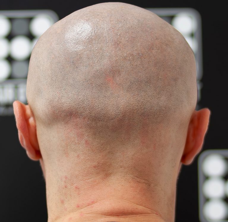 cicatrici implant de par micropigmentare scalp