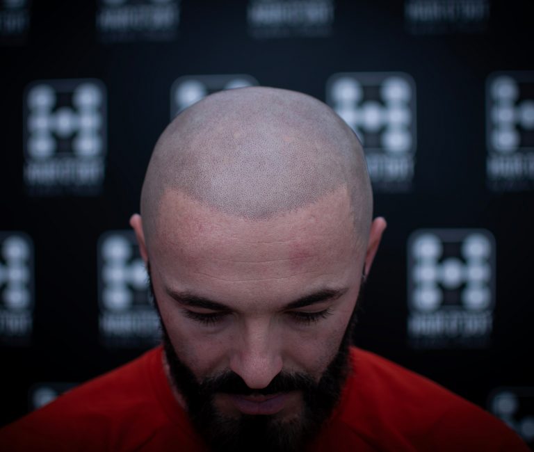 Micropigmentare Scalp Scalp Micropigmentation