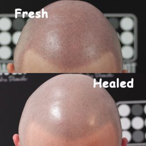Scalp Micropigmentation