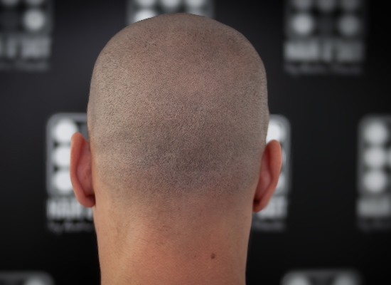 Micropigmentare Scalp Scalp Micropigmentation Cicatrici Implant de par