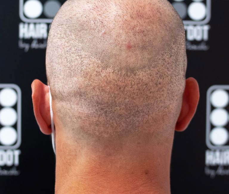 Micropigmentare Scalp Scalp Micropigmentation Cicatrici Implant de par