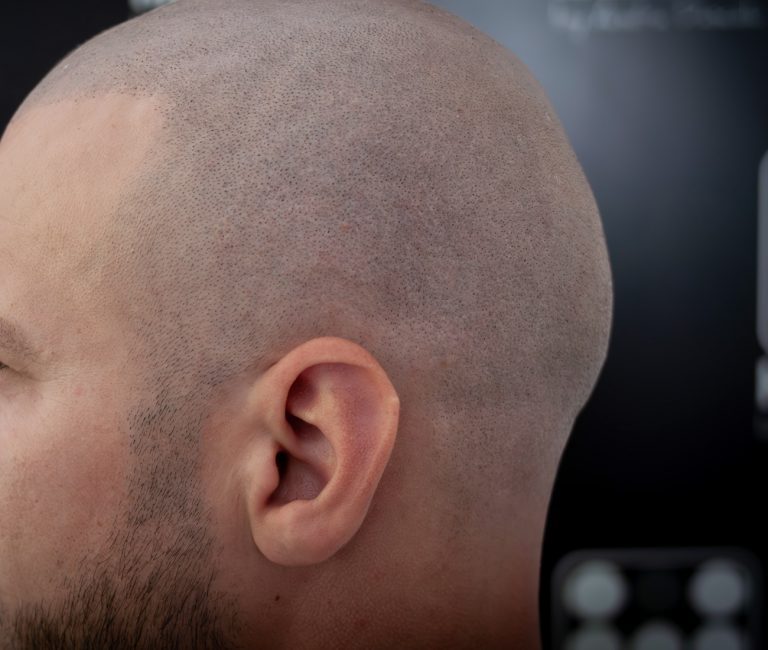 Micropigmentare Scalp Scalp Micropigmentation Cicatrici Implant de par