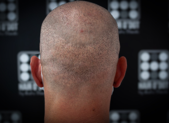Micropigmentare Scalp Scalp Micropigmentation Cicatrici Implant de par