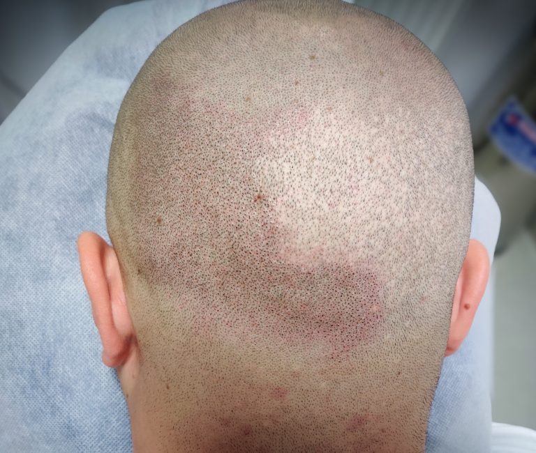 Micropigmentare Scalp Scalp Micropigmentation Cicatrici Implant de par
