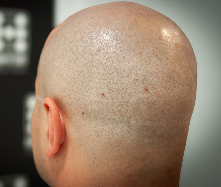 Micropigmentare Scalp Scalp Micropigmentation Cicatrici Implant de par