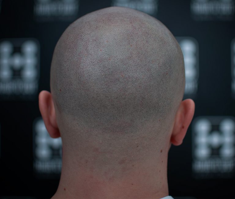 Micropigmentare Scalp Scalp Micropigmentation Cicatrici Implant de par