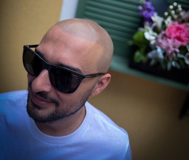 Micropigmentare Scalp Scalp Micropigmentation