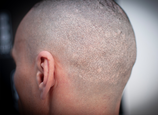 Micropigmentare Scalp Scalp Micropigmentation Cicatrici Implant de par