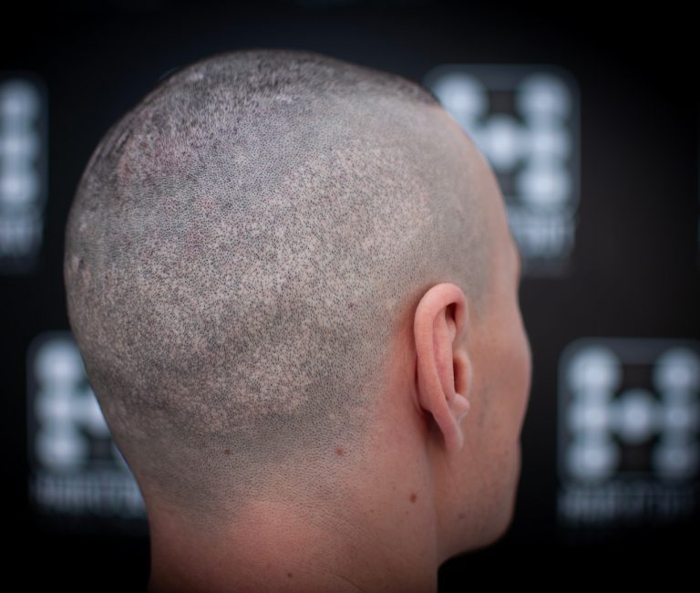 Micropigmentare Scalp Scalp Micropigmentation Cicatrici Implant de par