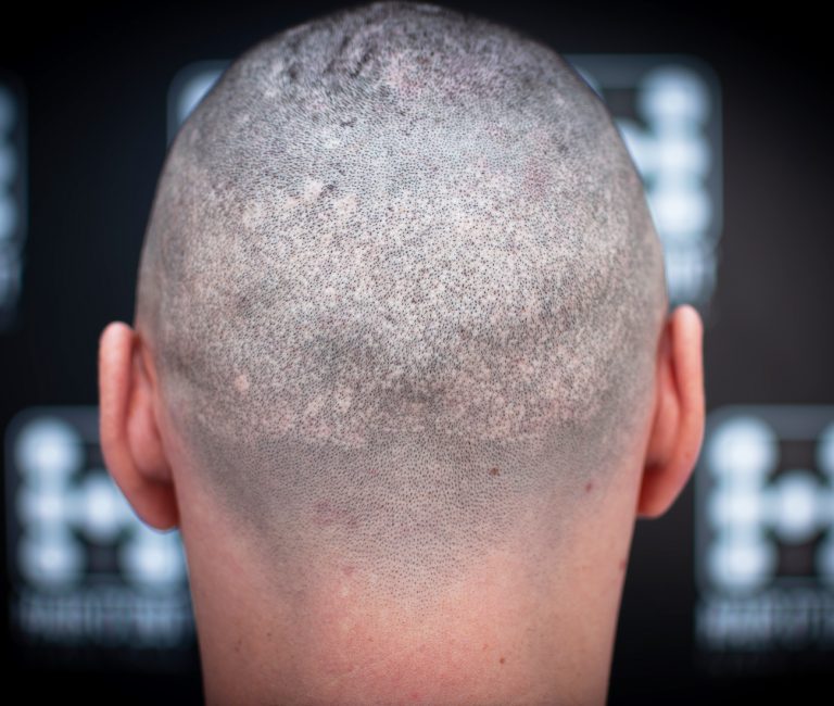 Micropigmentare Scalp Scalp Micropigmentation Cicatrici Implant de par