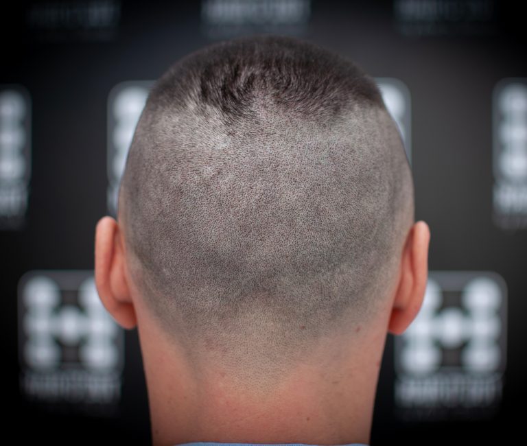 Micropigmentare Scalp Scalp Micropigmentation Cicatrici Implant de par