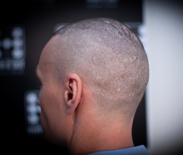 Micropigmentare Scalp Scalp Micropigmentation Cicatrici Implant de par